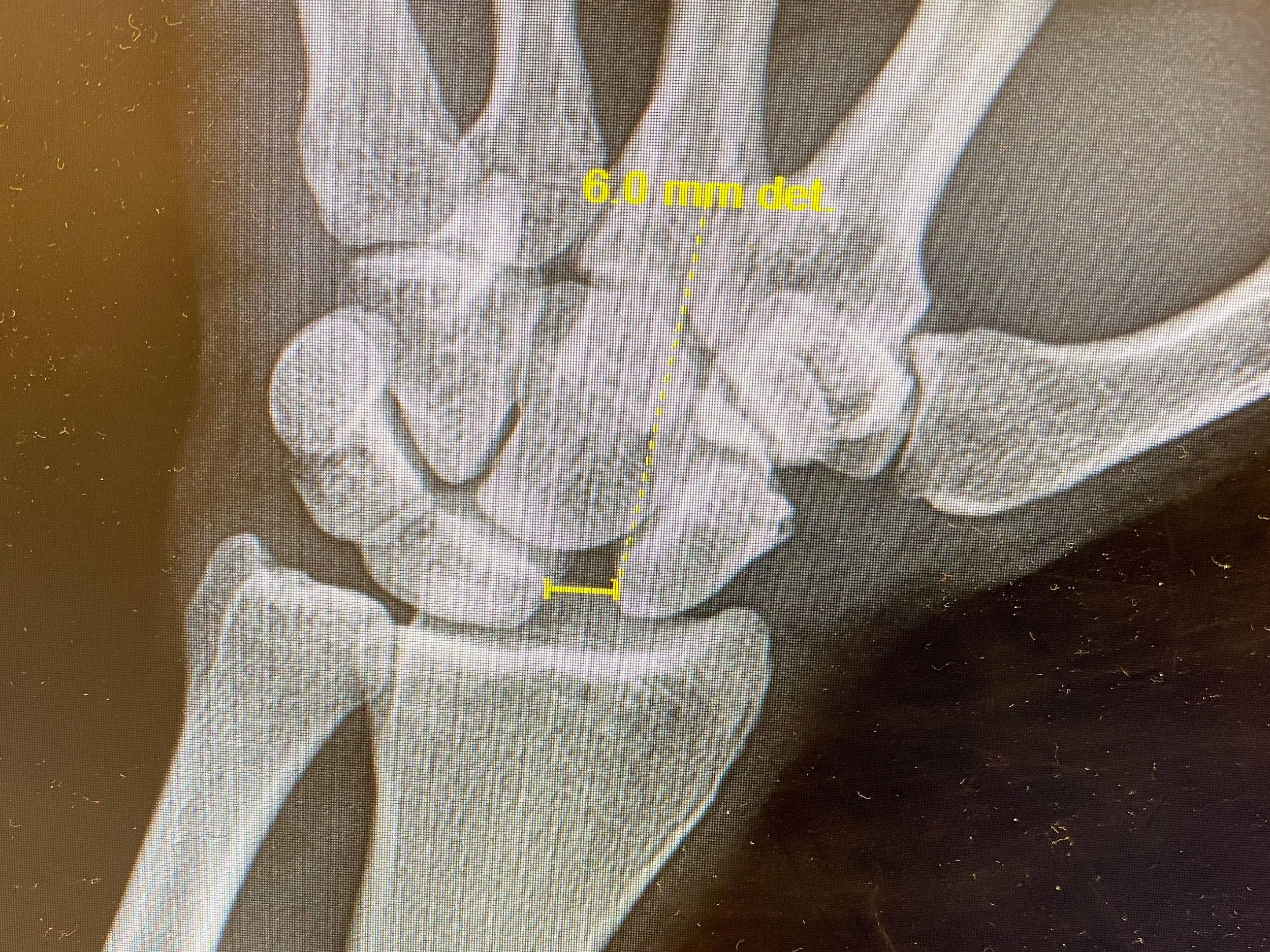 x-ray of broken wrist