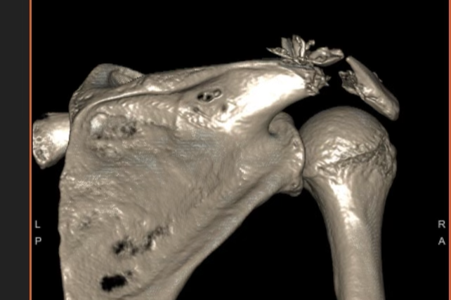 grizzly bear attack shayne patrick teton national park wyoming