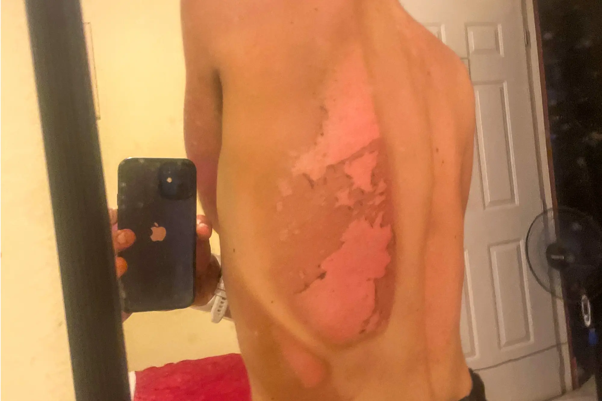 Bond Almand's sunburned back