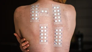patch test