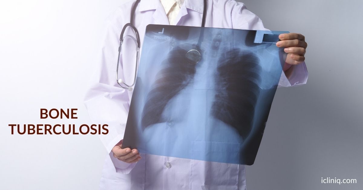 Know How Our iCliniq Doctor Helped a Patient With Bone Tuberculosis (TB)