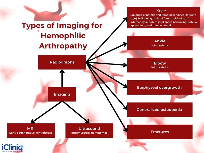 What Is Hemophilic Arthropathy?