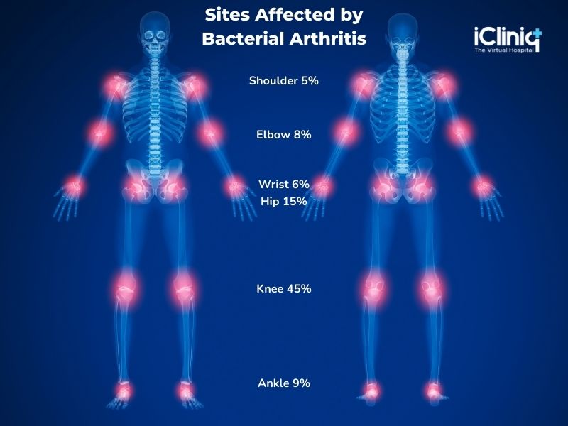 What Is Bacterial Arthritis?