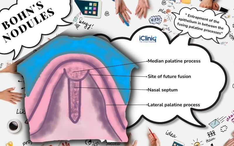 What Are Bohn s Nodules 