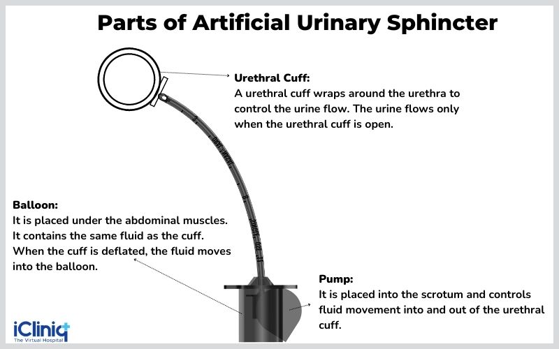 What Is an Artificial Urinary Sphincter?