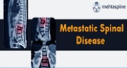 Metastatic Spinal Disease | Its Treatment Options