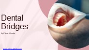 What is Dental Bridges?