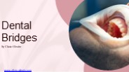 What is Dental Bridges? (1)