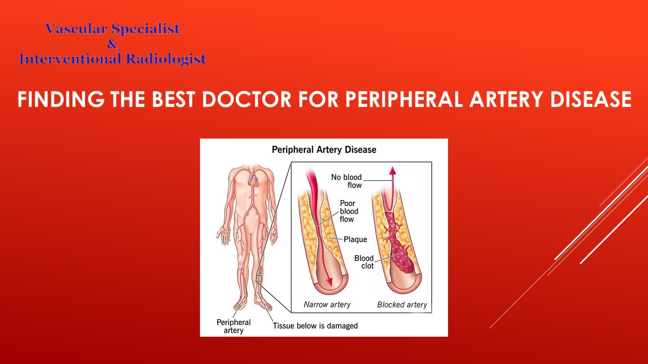 Finding the Best Doctor for Peripheral Artery Disease