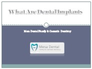 What Are Dental Implants