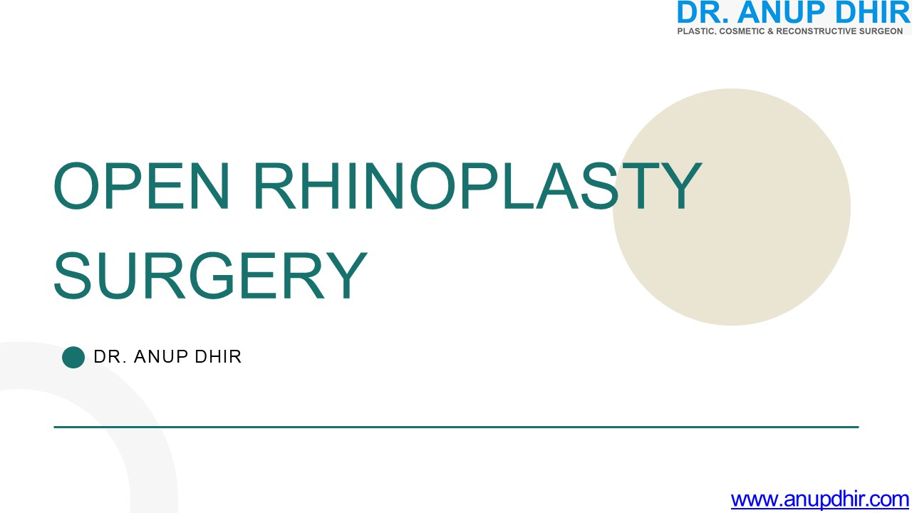 Open Rhinoplasty Surgery- Dr. Anup Dhir