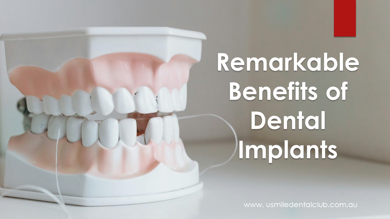 Remarkable Benefits of Dental Implants
