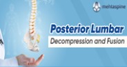 Posterior Lumbar Decompression and Fusion (PLDF)