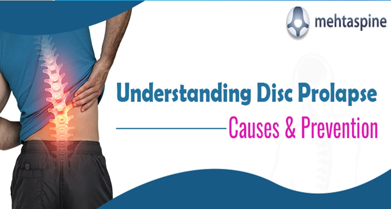 Understanding Disc Prolapse: Causes, Complications ; Prevention