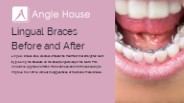 Lingual Braces Before and After