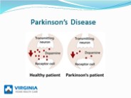 Symptoms of parkinsons