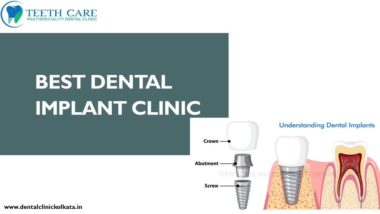 Discovering  Your Perfect Smile: The Best Dental Implant Clinic in Kolkata