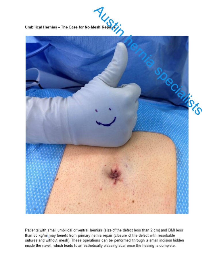 umbilical hernia with Austin hernia specialists