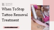 When To Stop Tattoo Removal Treatment?