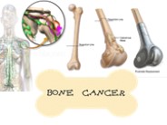 Bone Cancer: Understanding the Disease & Homeopathy Treatment Options