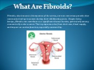Uterrine Fibroid Embolization
