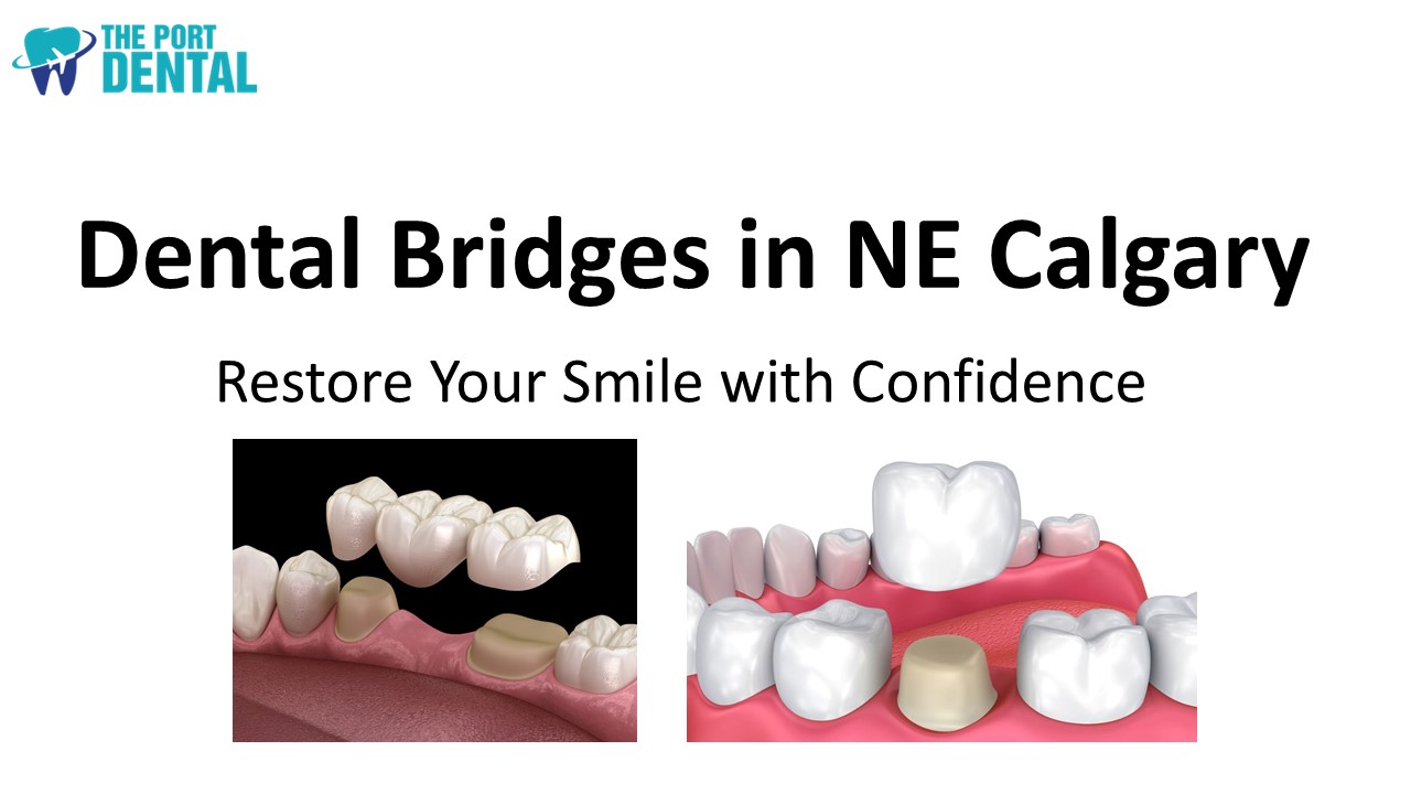 Dental Bridges in NE Calgary: Reclaim Your Complete Smile