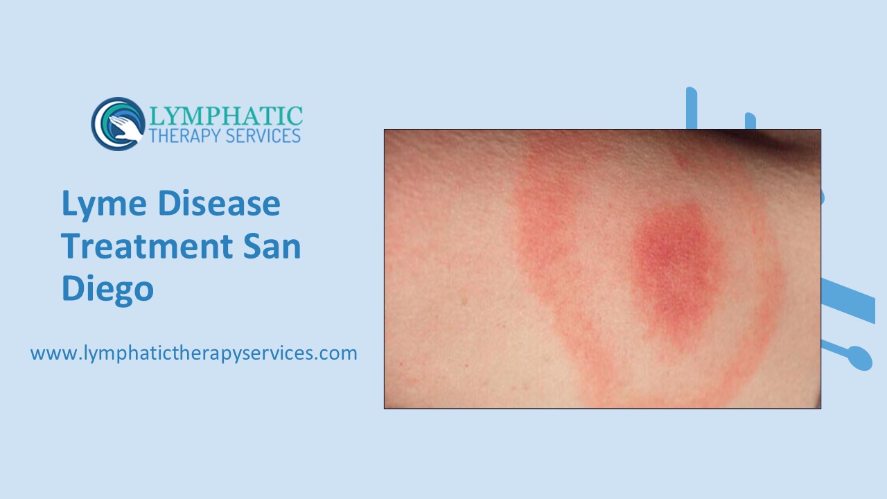 Lyme Disease Treatment San Diego
