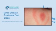 Lyme Disease Treatment San Diego (1)