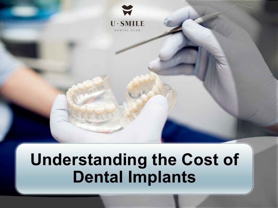 Understanding the Cost of Dental Implants