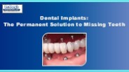 Dental Implants: The Permanent Solution to Missing Teeth
