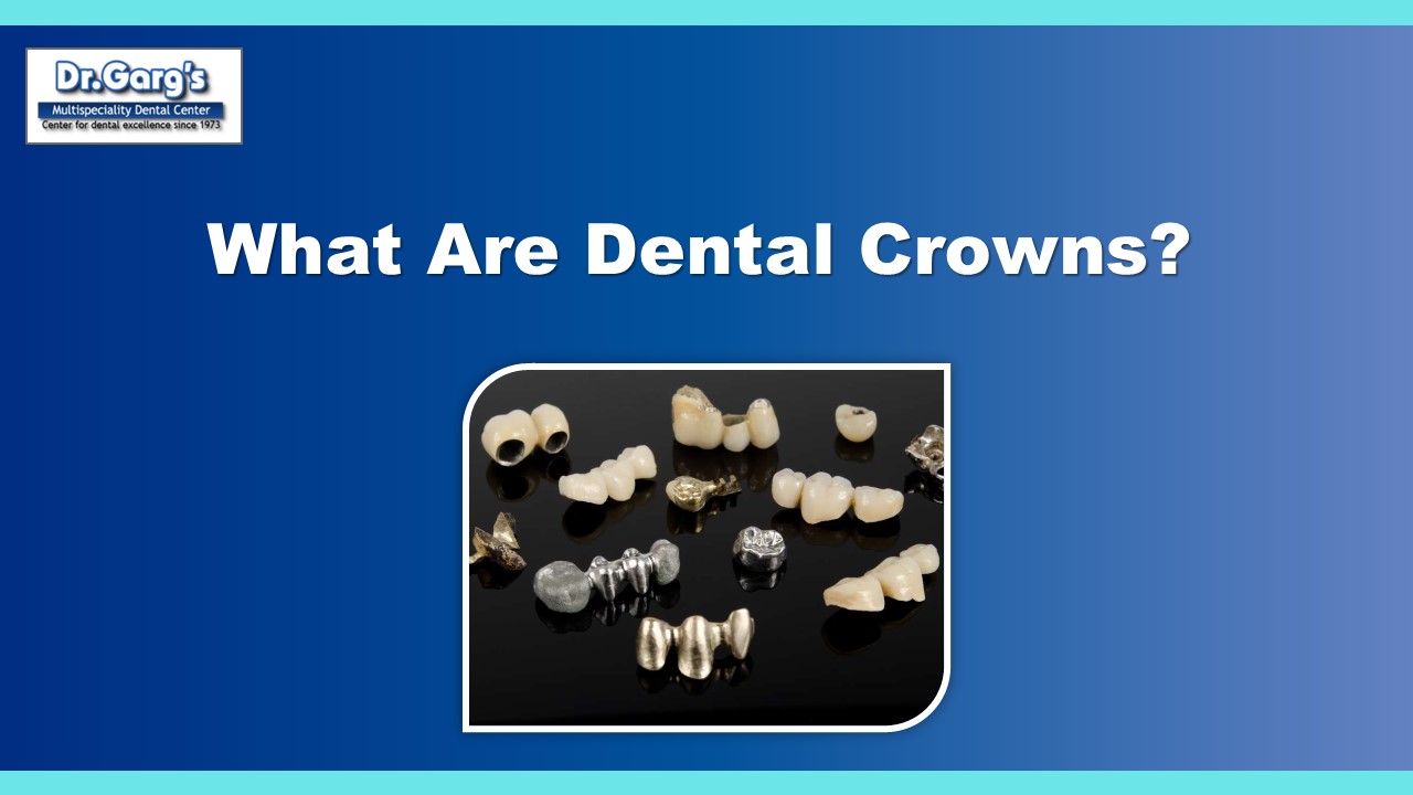 What Are Dental Crowns?