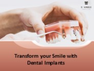 Transform your Smile with Dental Implants