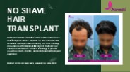 No Shave Hair Transplant