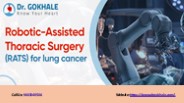 Robotic-Assisted Thoracic Surgery (RATS) for lung cancer