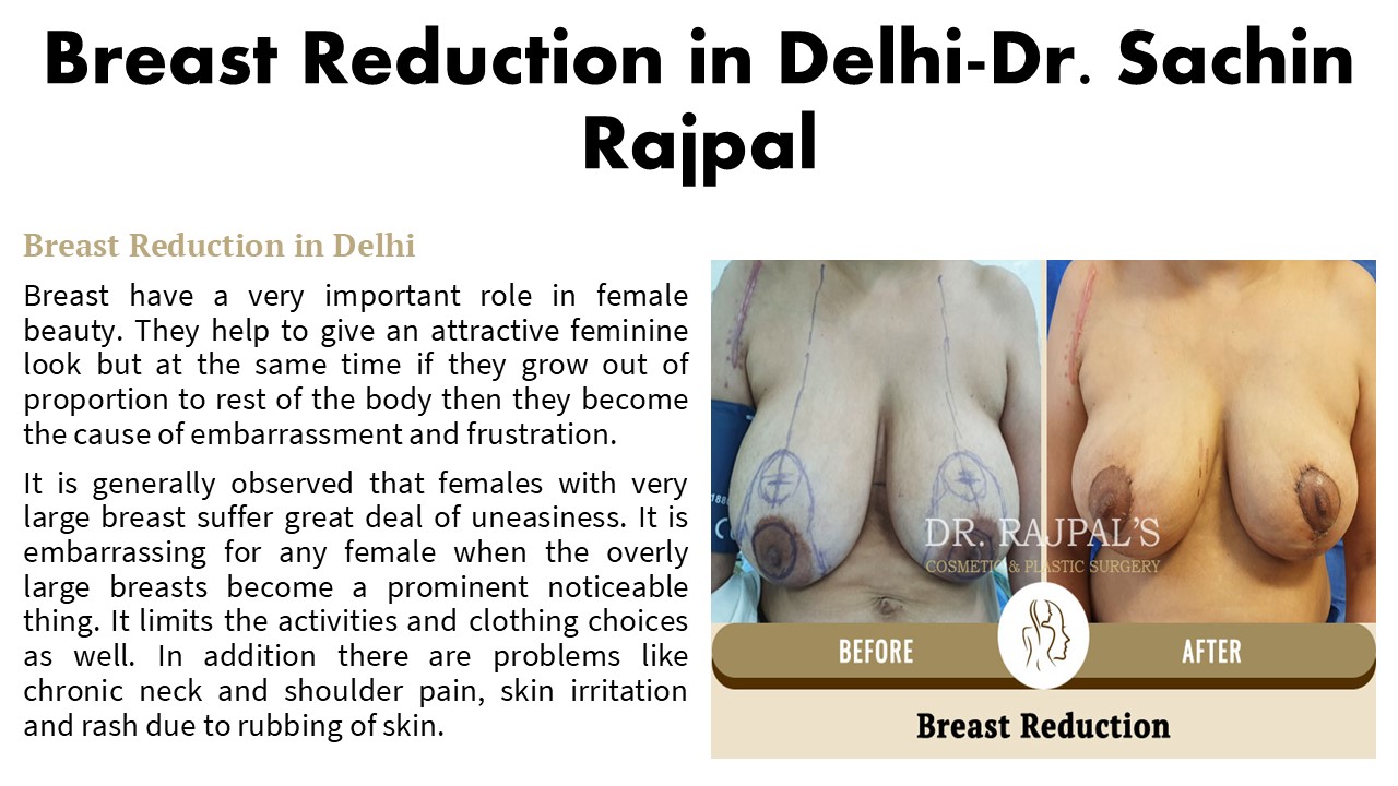 Breast Reduction in Delhi-Dr. Sachin Rajpal