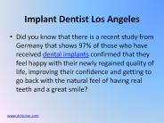 Los Angeles Dental Implants