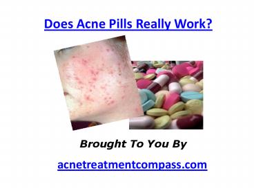 Does Acne Pills Really Work?