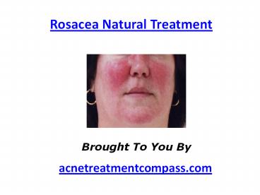 Rosacea Natural Treatment
