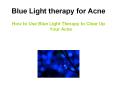 Blue Light Therapy for Acne