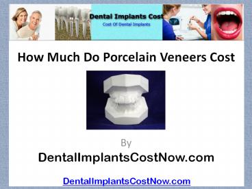 How Much Do Porcelain Veneers Cost