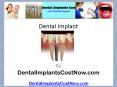 Dental Implant (1) PowerPoint PPT Presentation