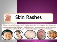 Frequent Winter Rashes and Skin Disorders - Fully grasp Some Typical Rash Troubles PowerPoint PPT Presentation