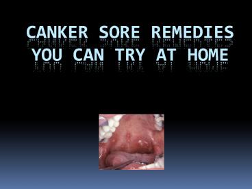 Top Canker Sore Treatments You Can Try at Home