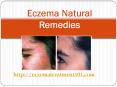 Eczema Natural Remedies PowerPoint PPT Presentation