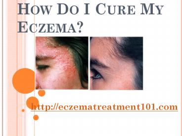 How Do I Cure My Eczema