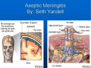 Aseptic Meningitis By: Seth Yandell