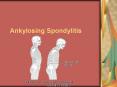 Ankylosing Spondylitis PowerPoint PPT Presentation