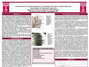 Costotransverse Articulation Injections for Treatment of Posterior Shoulder Girdle Pain Katie Gollotto, DO, Michael M. Weinik, DO Department of Physical Medicine & Rehabilitation Temple University Hospital, Philadelphia, PA