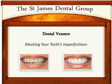 Dental Veneers: Cover your Teeth's Imperfections with Dental Veneers