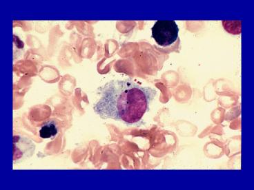 Histiocytic Syndromes